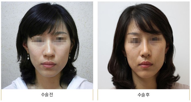 코성형 수술 후